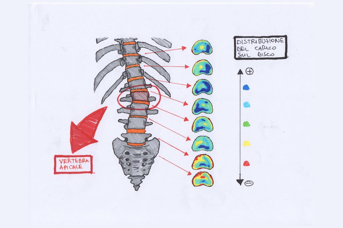 Sviluppo della scoliosi: perché  può peggiorare nella crescita?