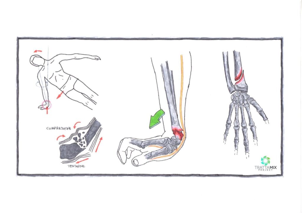 Frattura Di Colles Scaled 1