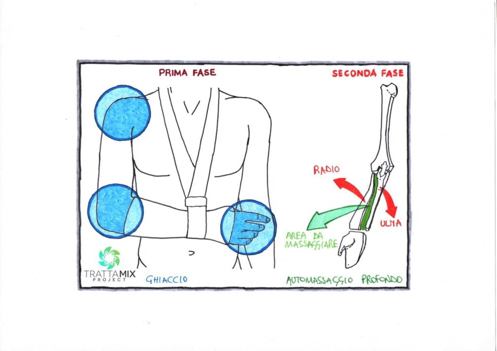 Frattura Polso Riabilitazione A Casa Scaled 1