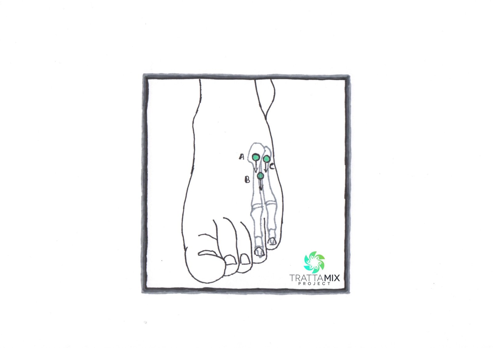 Frattura mignolo piede camminare GUIDA COMPLETA – TrattaMIX