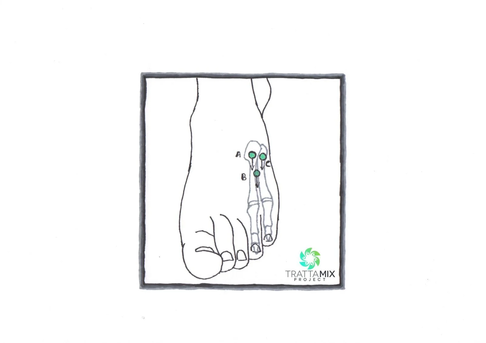 Frattura mignolo piede camminare GUIDA COMPLETA – TrattaMIX