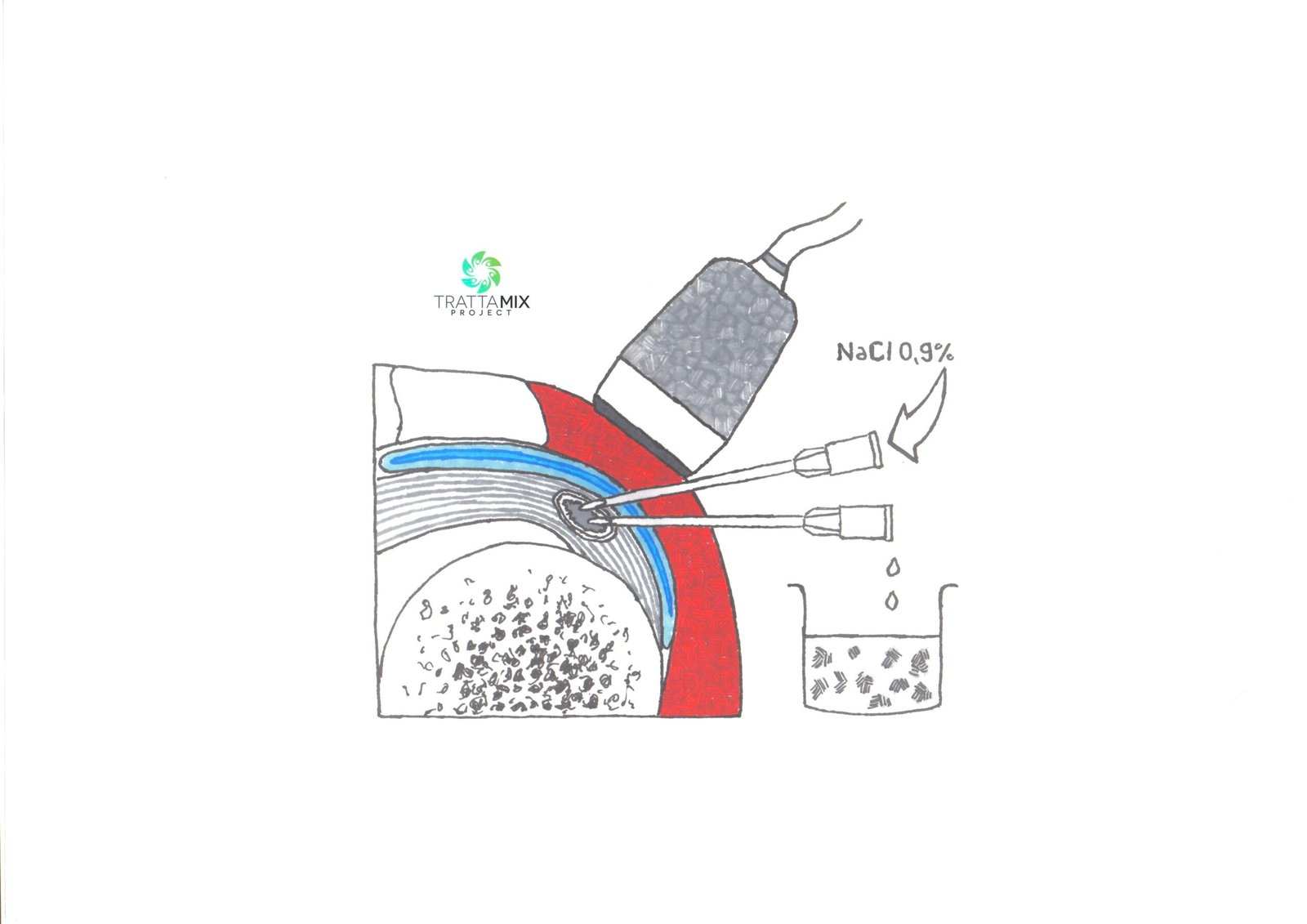 Lavaggio calcificazione spalla tempi di recupero – TrattaMIX UDINE